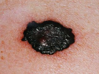 czerniak złośliwy skóry - typ guzkowaty - przykład 1