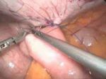 Jejunostomia - zabieg laparoskopowy