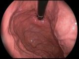 Gastroskopia - obraz z badania, widoczne wnętrze żołądka oraz przewód endoskopu