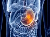 rak żołądka – ilustracja poglądowa