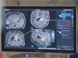 operacja guza mózgu metodą ablacji laserowej pod kontrolą rezonansu magnetycznego