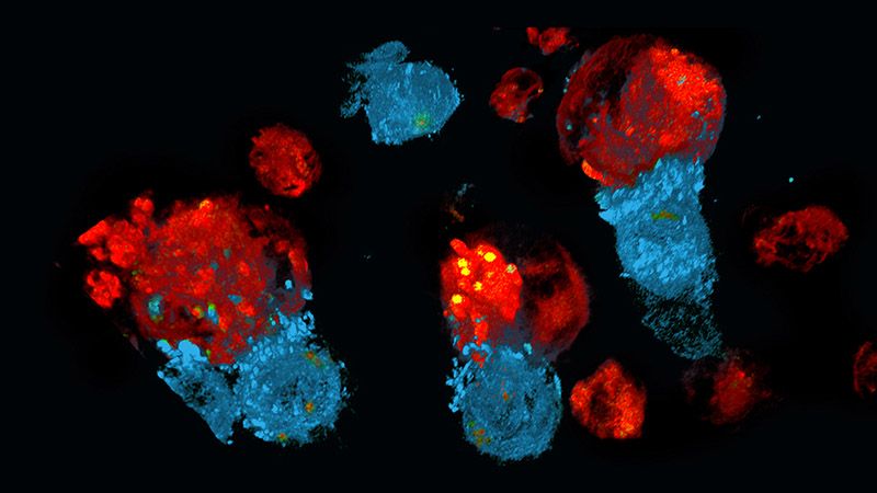 wizualizacja komórek chłoniaka 