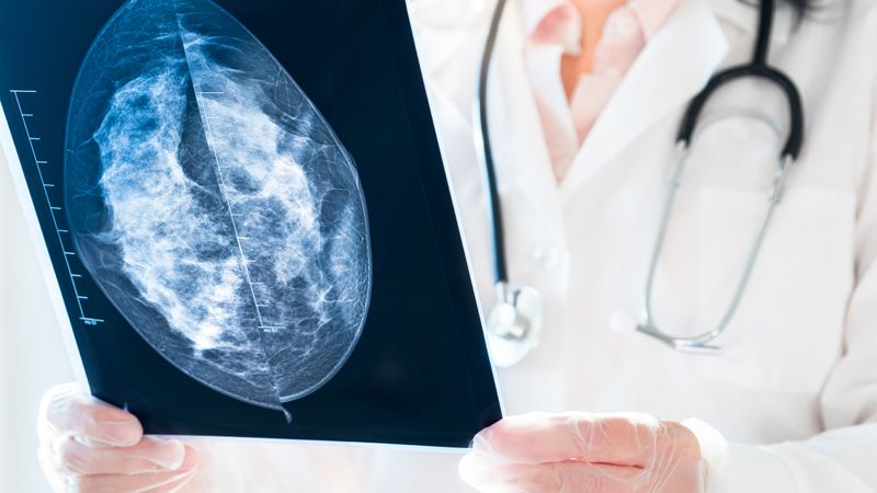 Rak piersi w badaniu obrazowym – ilustracja poglądowa
