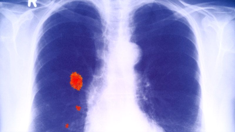 rak płuca – ilustracja poglądowa
